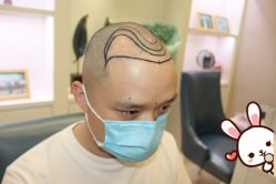 -大麦微针植发丨全国连锁