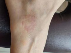 -杭州仁易堂中医康复医院疤痕修复
