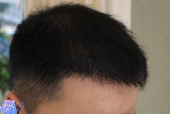 -大麦微针植发丨全国连锁
