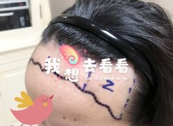 -大麦微针植发全国连锁