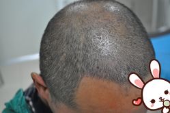 点击看大图 -大麦微针植发丨全国连锁