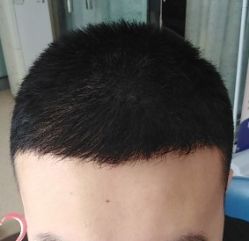 -大麦微针植发丨全国连锁