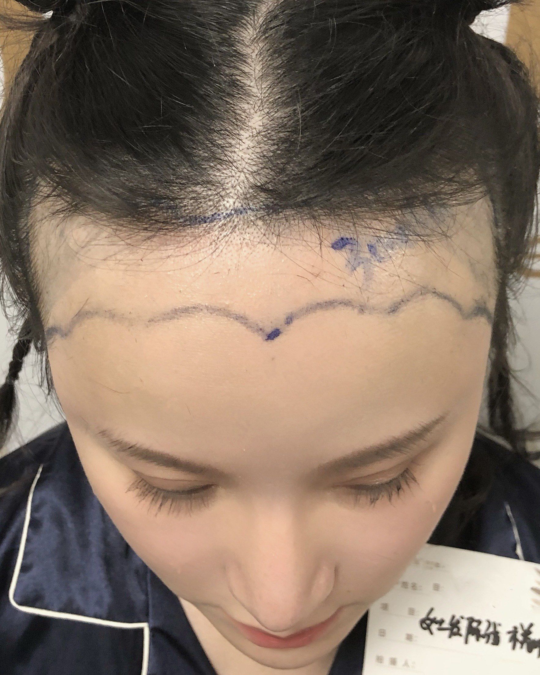 发际线种植惊喜对比