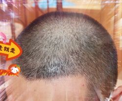 -大麦微针植发全国连锁