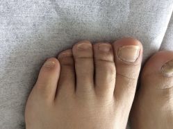 -德哥灰指甲脚气甲沟炎跖疣护理