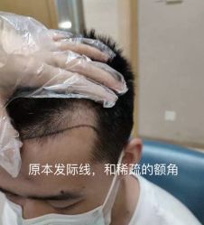 体验前-大麦微针植发全国连锁