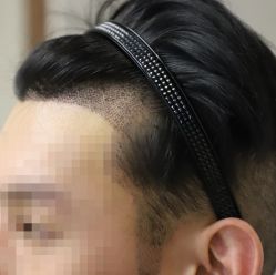 -大麦微针植发全国连锁