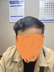 体验后-大麦微针植发全国连锁