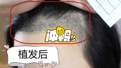 -大麦微针植发全国连锁