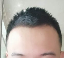 -大麦微针植发丨全国连锁