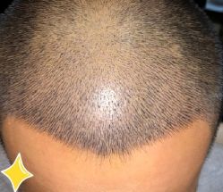 -大麦微针植发丨全国连锁