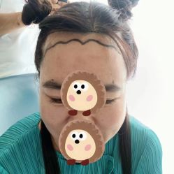 -大麦微针植发丨全国连锁