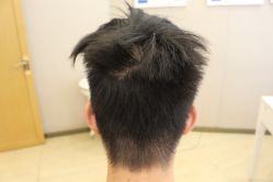 -大麦微针植发丨全国连锁