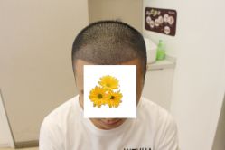 -大麦微针植发丨全国连锁