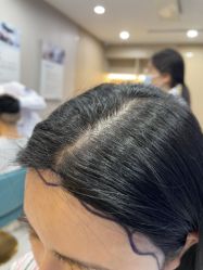 -碧莲盛不剃发植发
