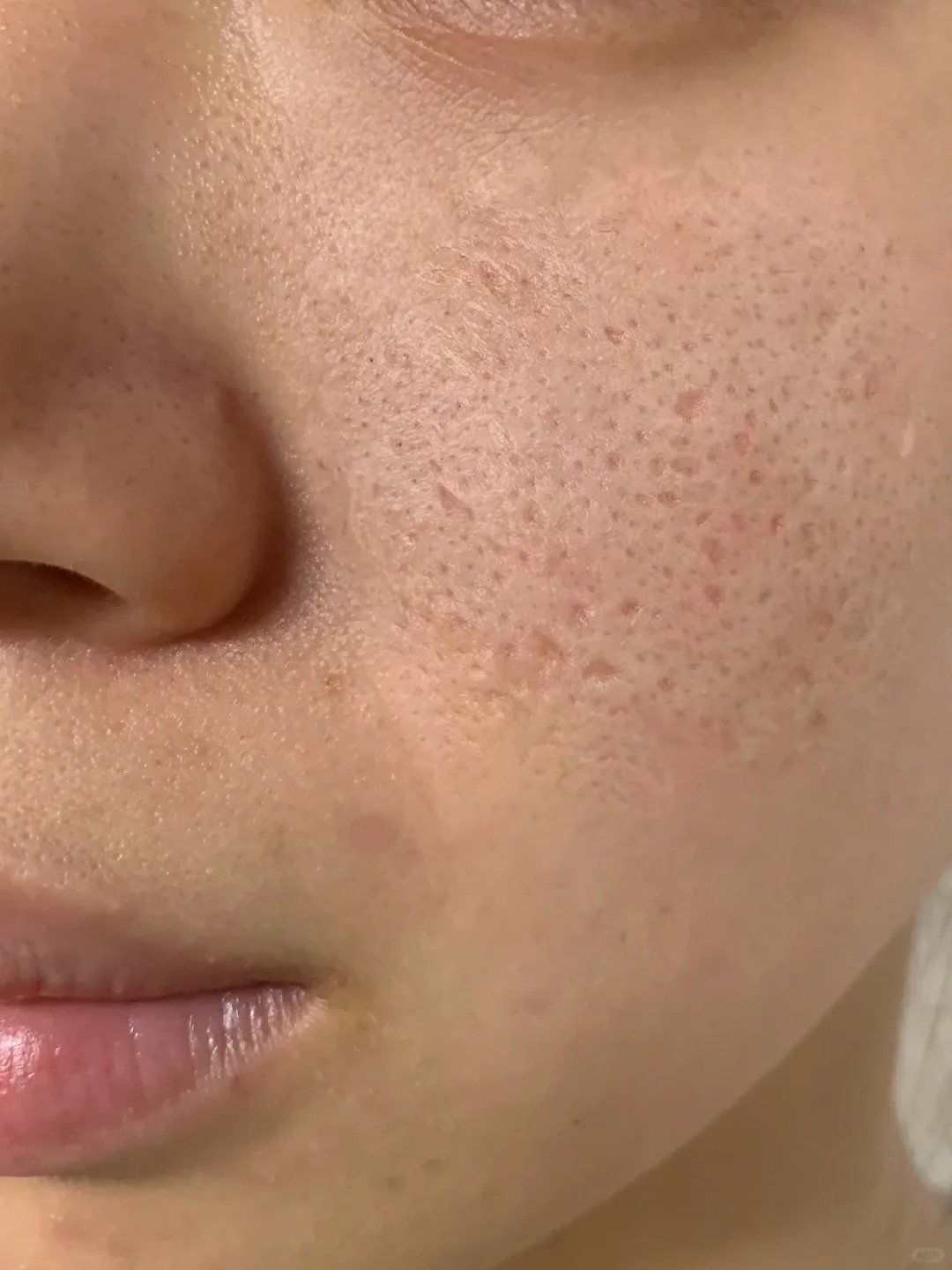 痘坑疤痕怎么消除