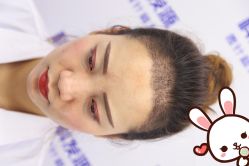 -大麦微针植发丨全国连锁