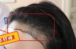 -大麦微针植发全国连锁