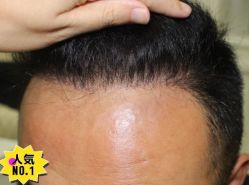 -大麦微针植发丨全国连锁