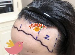 -大麦微针植发全国连锁