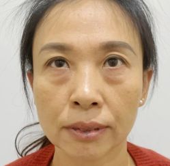体验前-广州健丽·去眼袋医疗美容机构