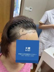 -大麦微针植发全国连锁