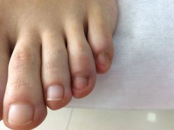-德哥灰指甲脚气甲沟炎跖疣护理