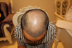 -大麦微针植发丨全国连锁