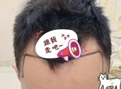 -大麦微针植发全国连锁