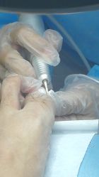 -派恩宜灰指甲鸡眼嵌甲手足癣