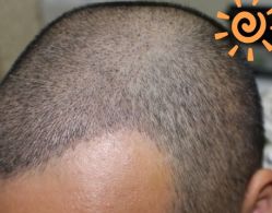 -大麦微针植发丨全国连锁