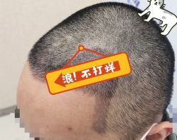 -大麦微针植发全国连锁