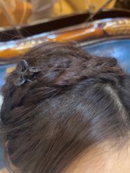 -碧莲盛·不剃发植发