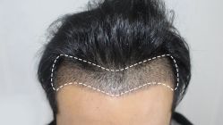 -大麦微针植发丨全国连锁