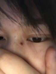 -爱莎扁平疣·汗管瘤·斑痣中心