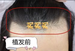 -大麦微针植发全国连锁