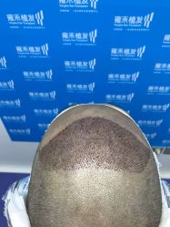 -雍禾植发全国连锁