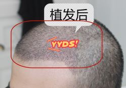 -大麦微针植发全国连锁