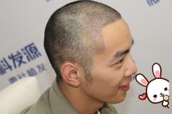 -大麦微针植发丨全国连锁