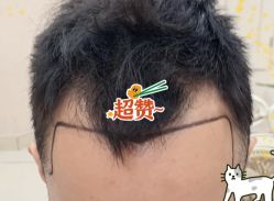 -大麦微针植发全国连锁