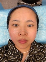 体验后-针美汇欧邦医疗美容
