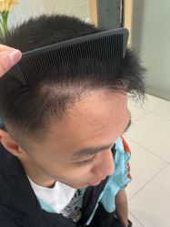 -大麦微针植发丨全国连锁