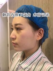 -大麦微针植发全国连锁