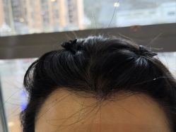 -碧莲盛·不剃发植发