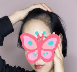 -大麦微针植发丨全国连锁