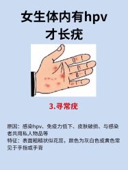 -美丽人生祛斑扁平疣汗管瘤中心