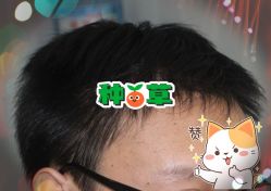 -大麦微针植发全国连锁