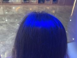 -碧莲盛·不剃发植发