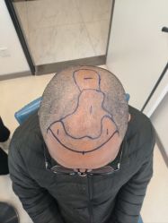 点击看大图 体验前-大麦微针植发丨全国连锁