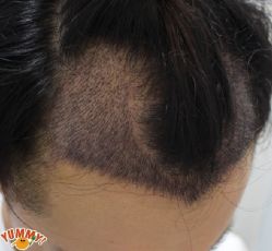 -大麦微针植发丨全国连锁